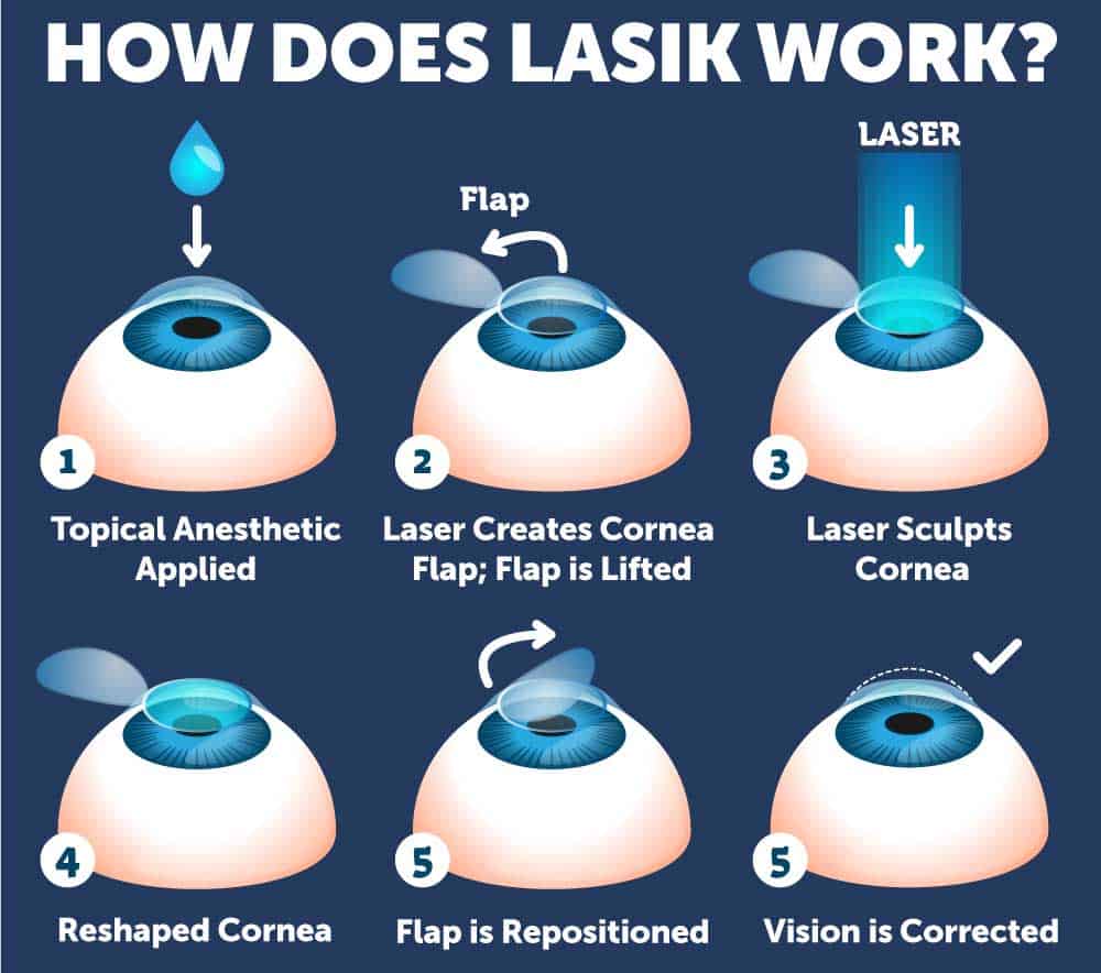 LASIKSurgery_Diagram