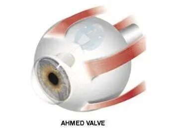 ahmed valve