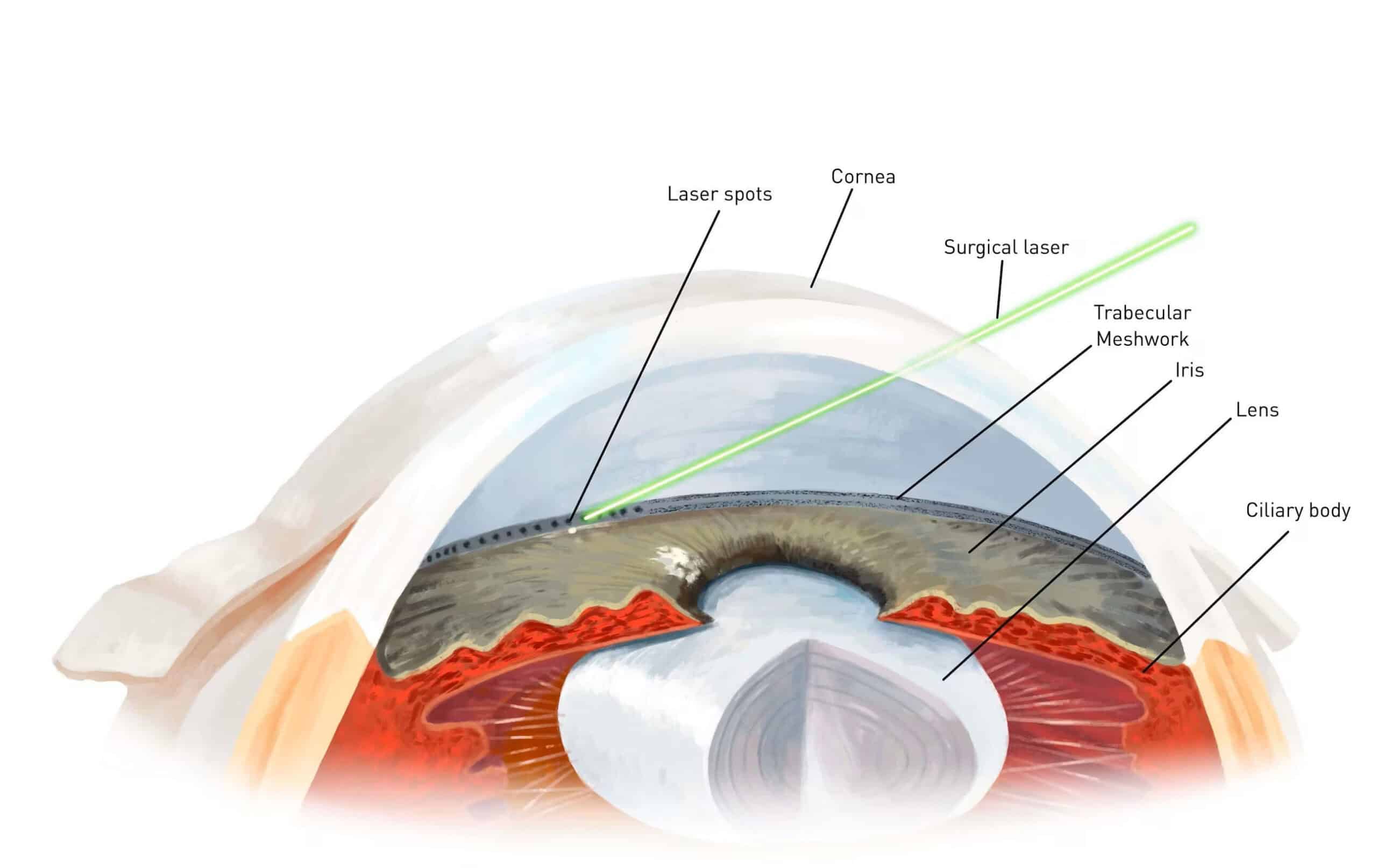 Selective Laser Trabeculoplasty